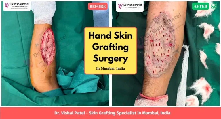 Hand fracture skin grafting in Mumbai India - Before After Surgery Photo