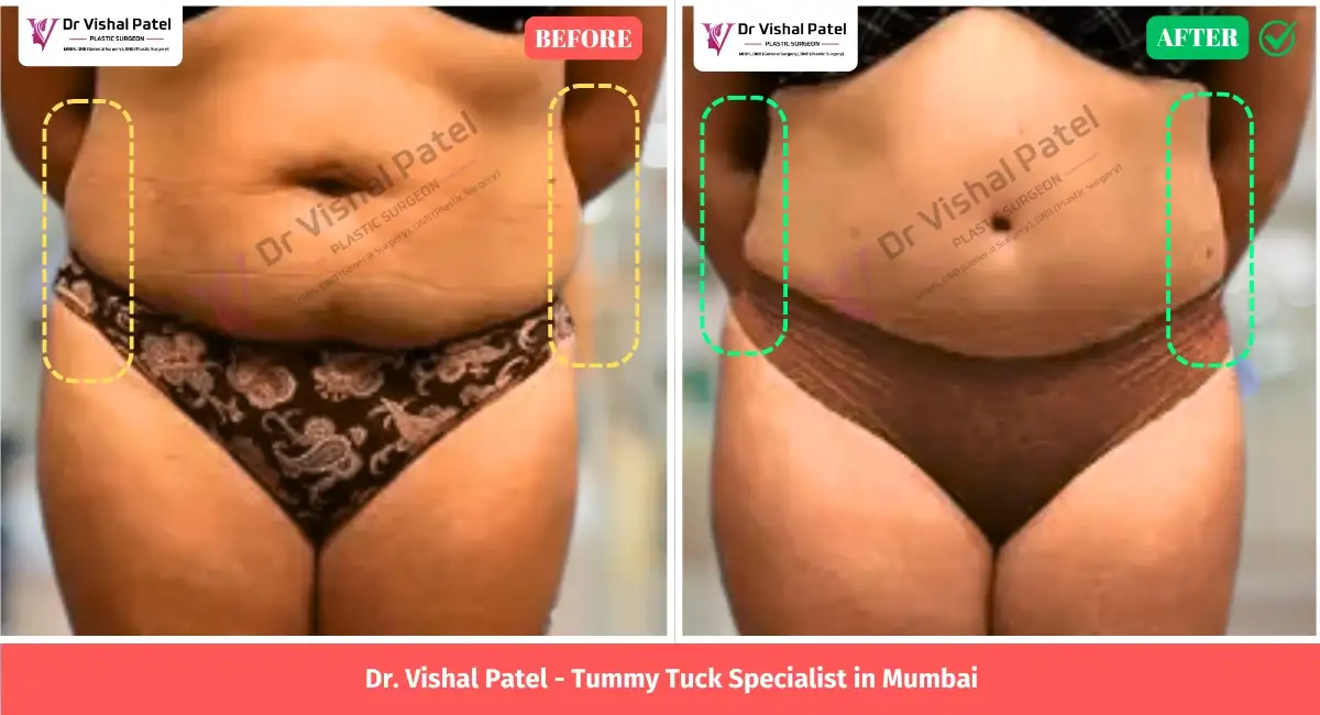 Liposuction Tummy Tuck in Mumbai - Before After Photo by Dr. Vishal Patel