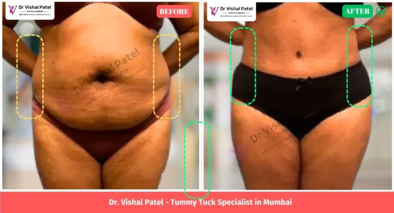 Tummy Tuck Before After Photo in India - by Dr. Vishal Patel