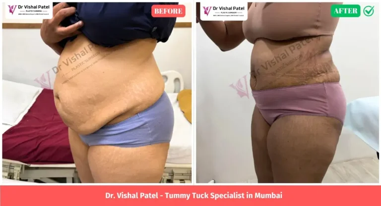 Tummy Tuck Before After Photos in Mumbai by Dr. Vishal Patel - Left Side View