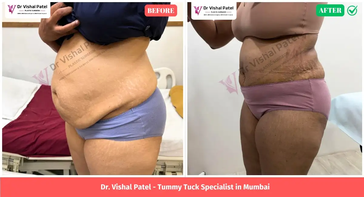 Tummy Tuck Before After Photos in Mumbai by Dr. Vishal Patel - Left Side View