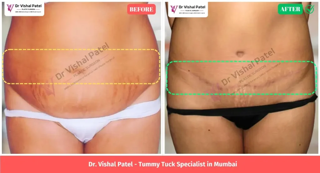 Tummy Tuck in Mumbai - Before After Photos of Surgery