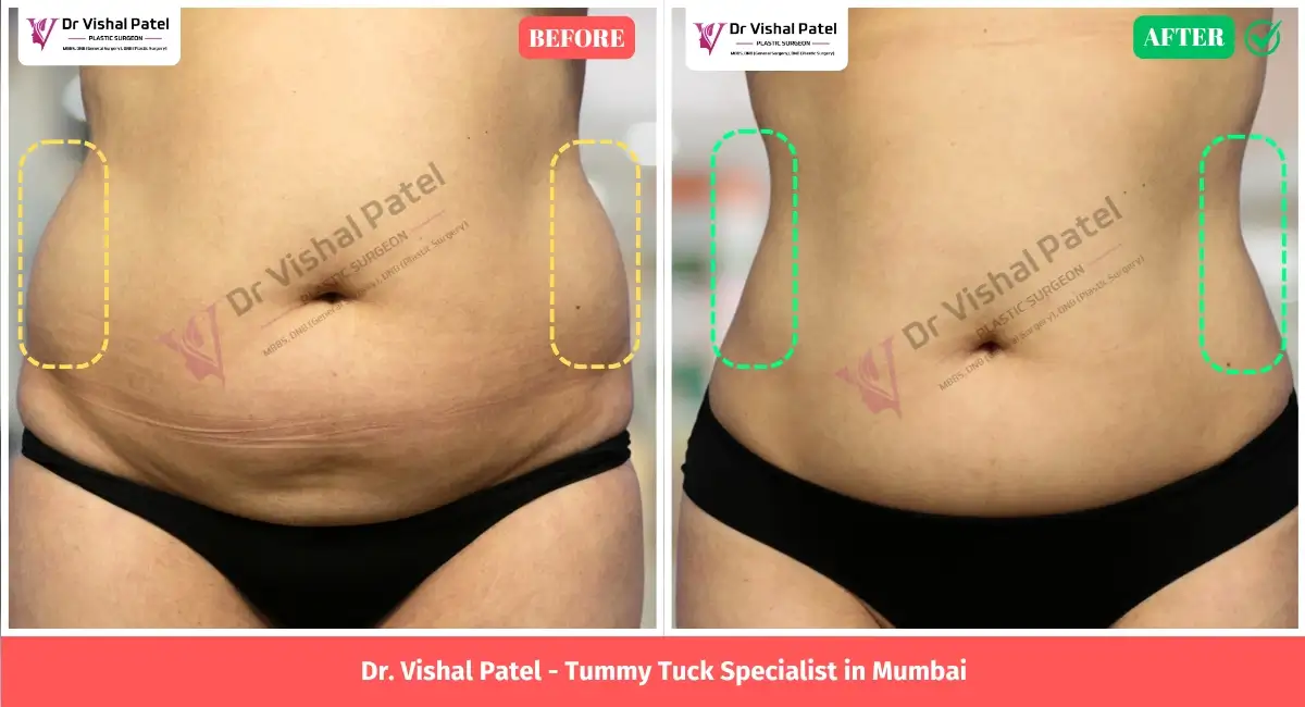 Tummy Tuck in Mumbai - Before and After Surgery Photo