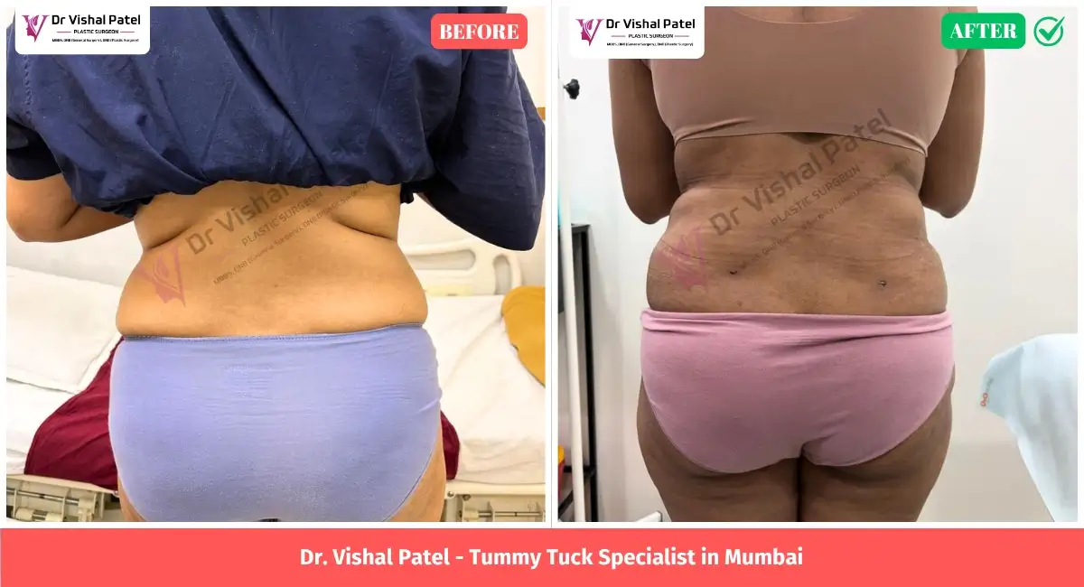 Tummy Tuck with 360 Liposuction Before After Photos in Mumbai by Dr. Vishal Patel