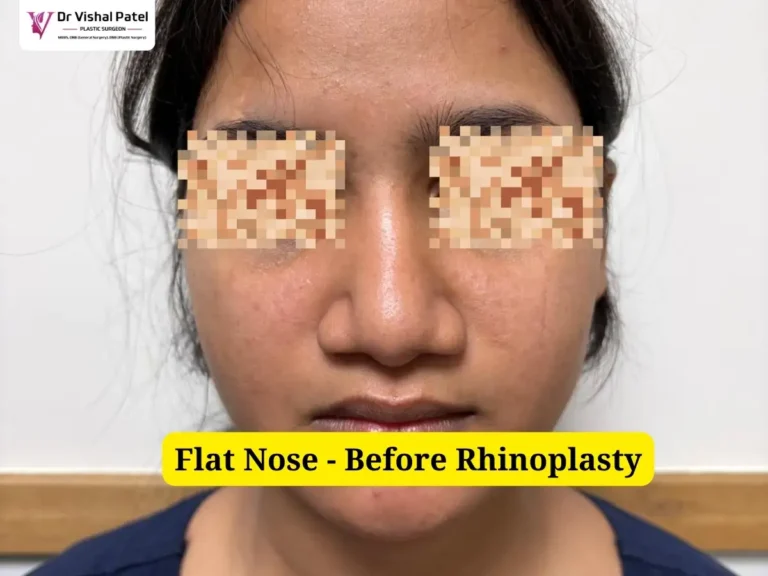 Flat Nose Rhinoplasty - Before Surgery Photo - Front View