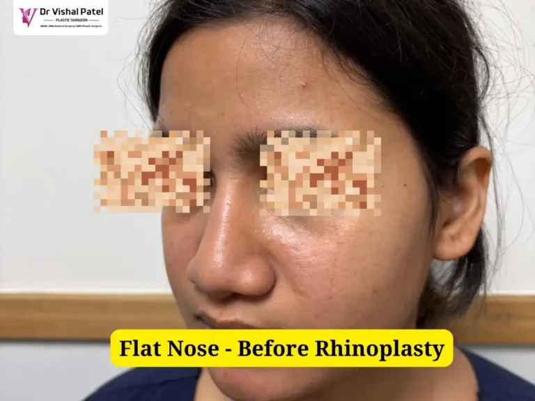 Flat Nose Rhinoplasty - Before Surgery Photo - Side View