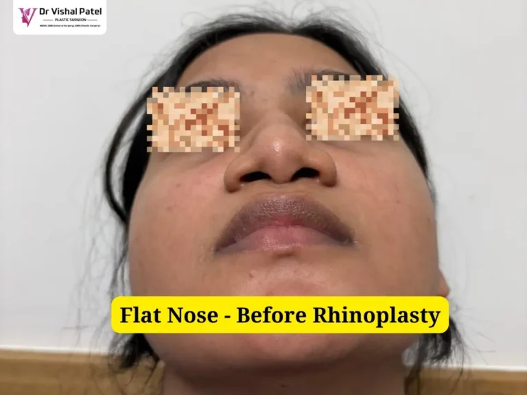 Flat Wide Nose Job - Bottom Side View - Before Rhinoplasty Photo