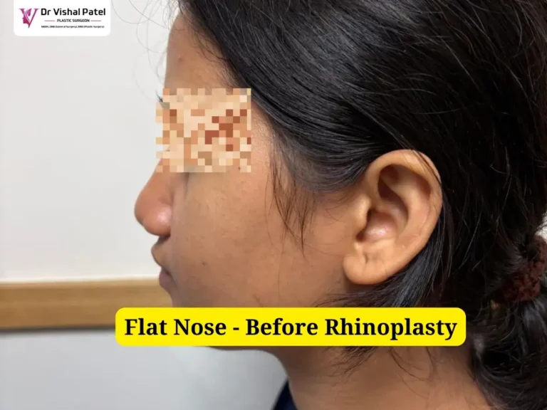 Flat Wide Nose Job - Left Side View - Before Rhinoplasty Photo
