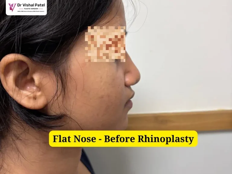 Flat Wide Nose Job - Right Side View - Before Rhinoplasty Photo