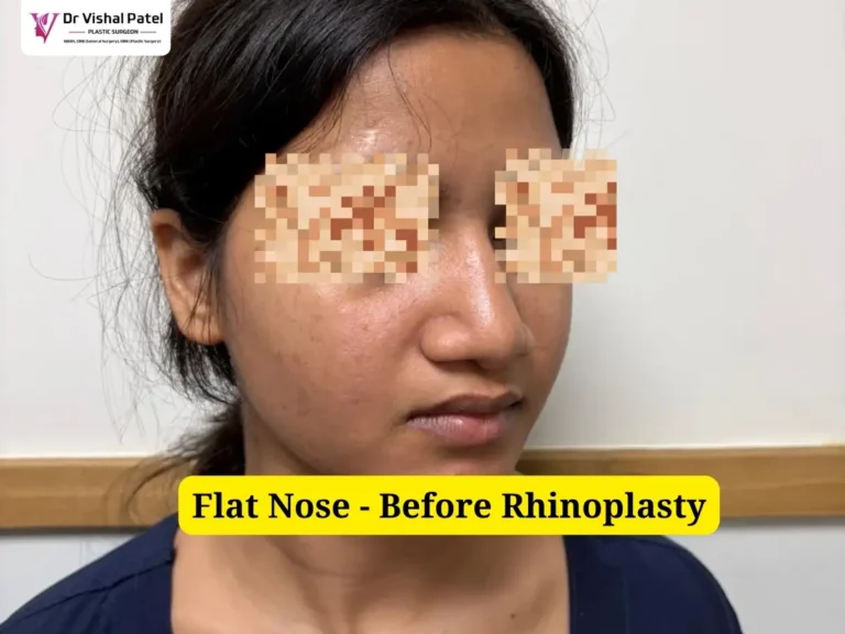 Wide Nose Rhinoplasty - Before Surgery Photo - Side Front View