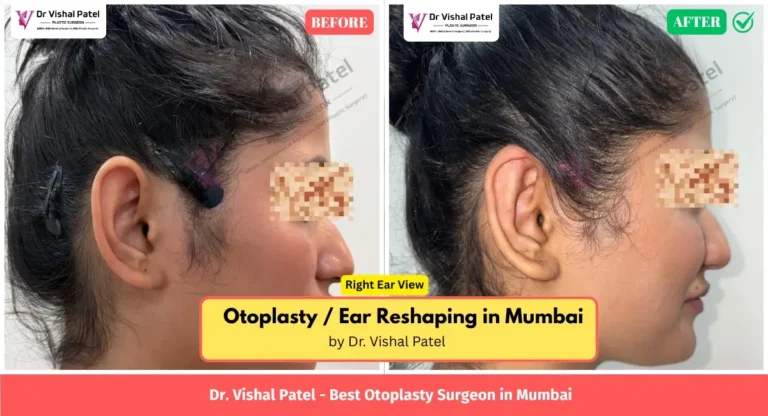 Otoplasty Before After Photos in India - By Dr. Vishal Patel - Right Ear View