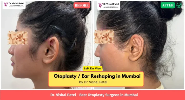 Otoplasty Before After Photos in Mumbai India - By Dr. Vishal Patel - Left Ear View