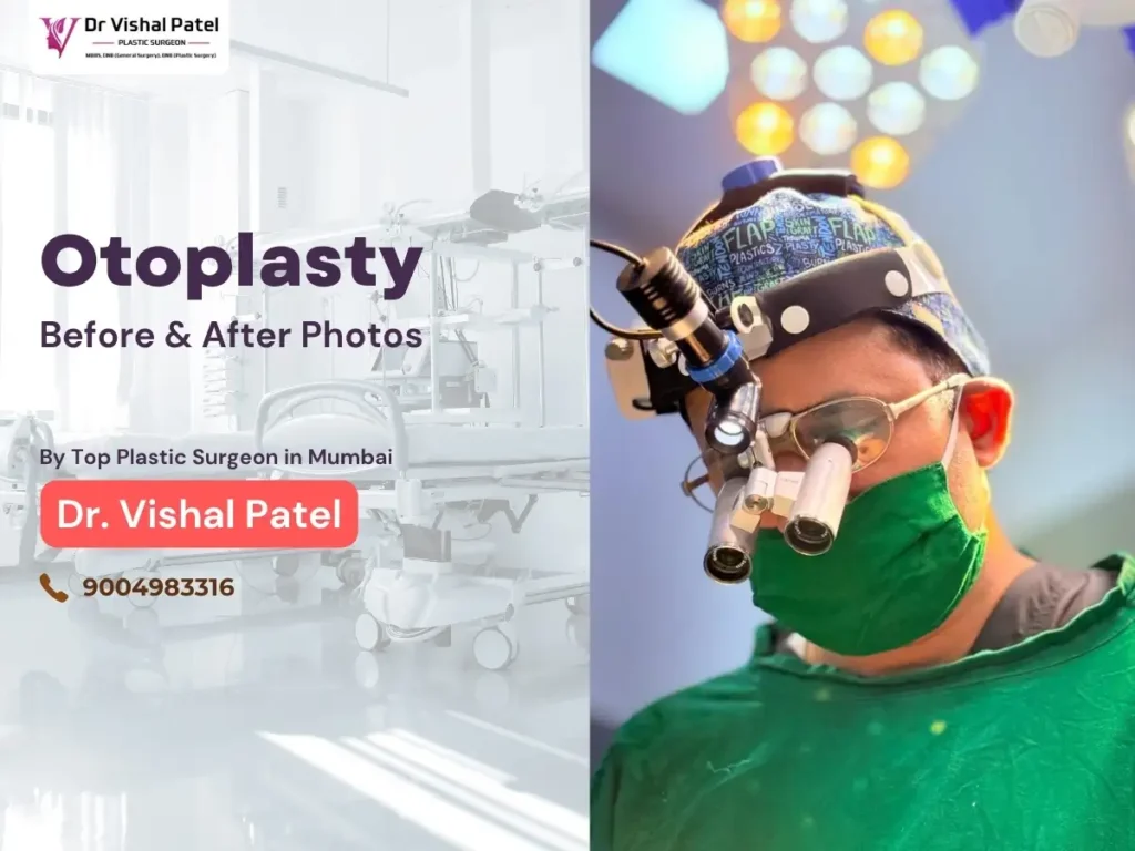 Otoplasty Before After Photos in Mumbai India by Dr. Vishal Patel