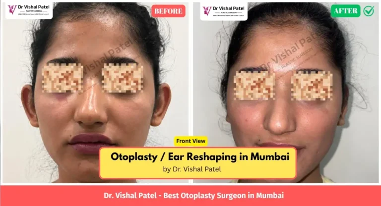 Otoplasty Surgery photos - Front Ear View