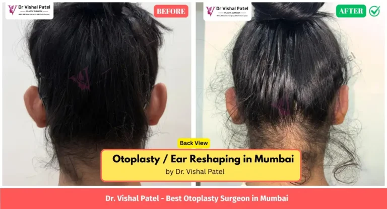 Otoplasty Surgery photos by Dr. Vishal Patel - Back Ear View