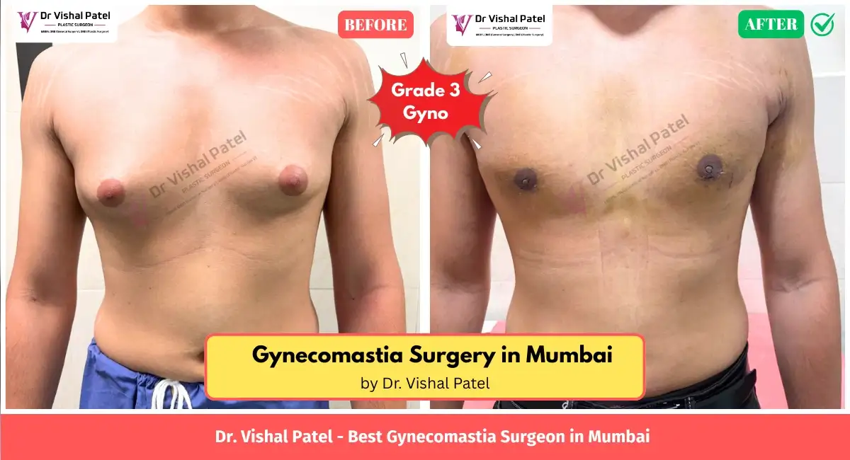 Grade 3 Gyno surgery in Mumbai by Dr. Vishal Patel - Before After Photo Front View