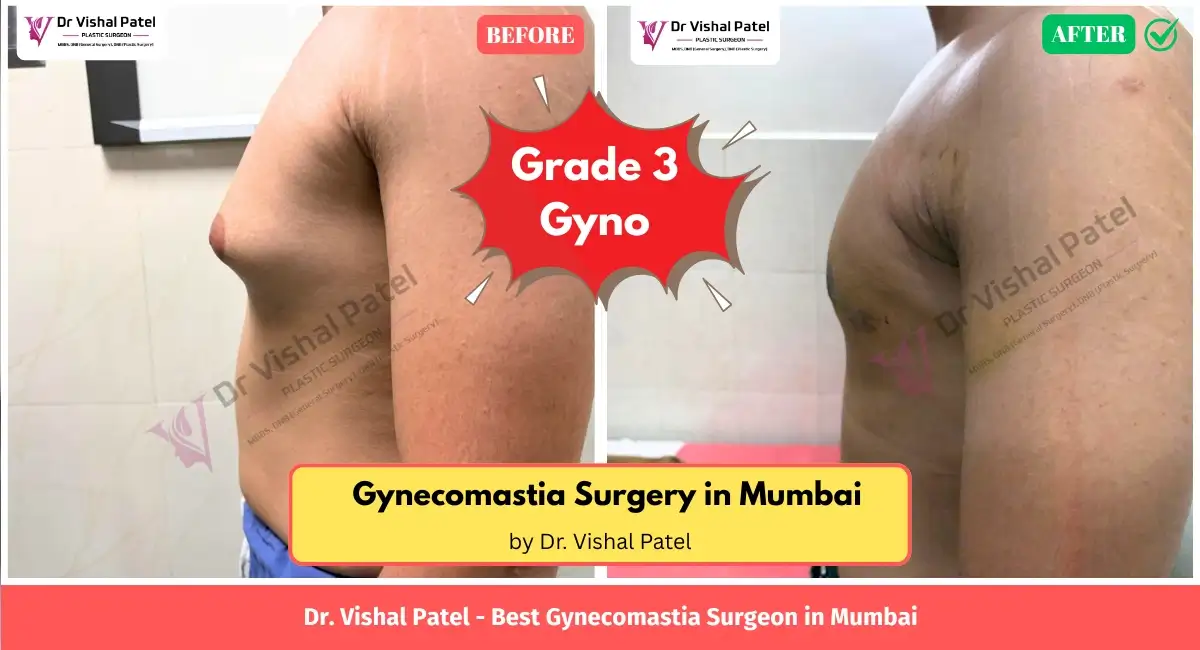 Grade 3 Gyno surgery in Mumbai by Dr. Vishal Patel - Before After Photo Left Chest View