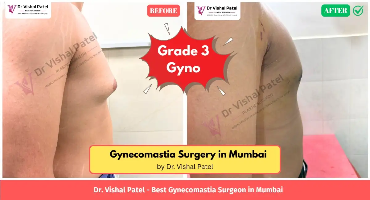 Grade 3 Gyno surgery in Mumbai by Dr. Vishal Patel - Before After Photo Right Chest View