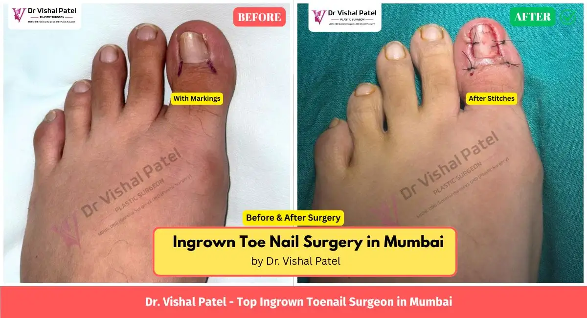 Ingrown Toe Nail Surgery in Mumbai by Dr. Vishal Patel - Before After Photo - June 2026