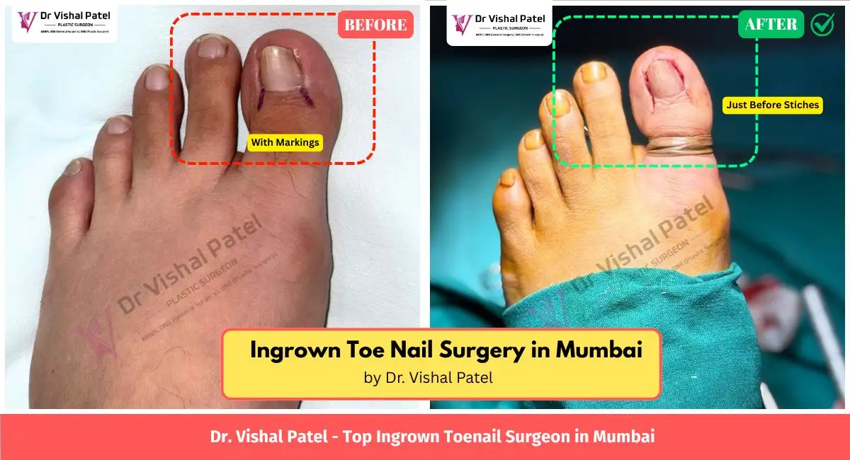 Ingrown Toe Nail Surgery in Mumbai by Dr. Vishal Patel - Just Before Stitches - June 2026