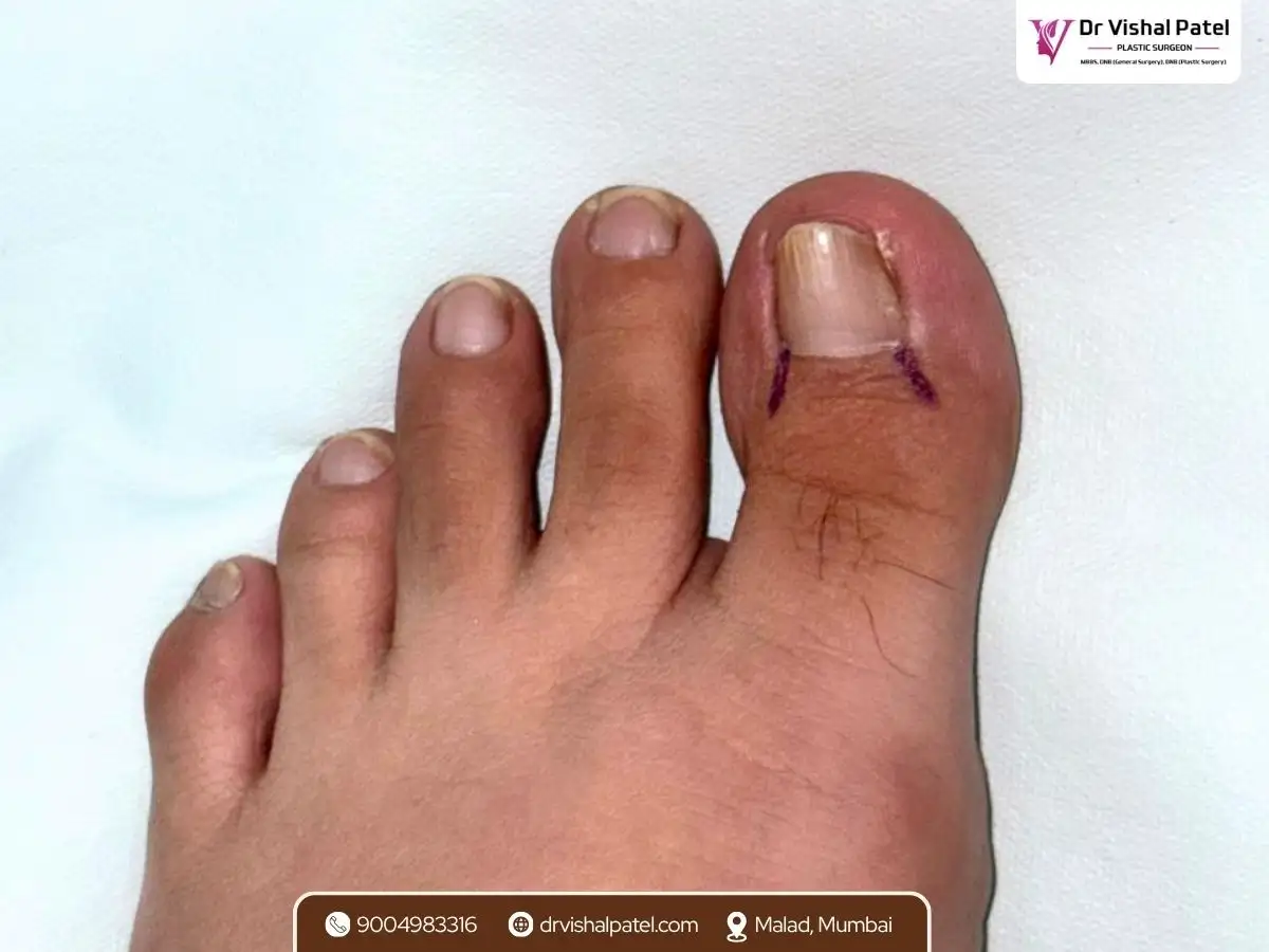 Ingrown Toenail with marking before surgery in Mumbai.
