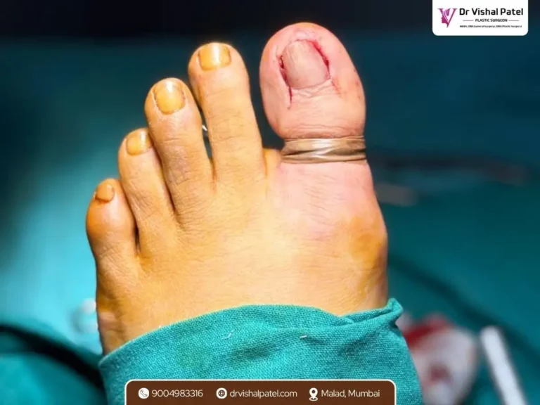 Toenail with tight rubber band to block blood supply during toenail surgery in Mumbai.