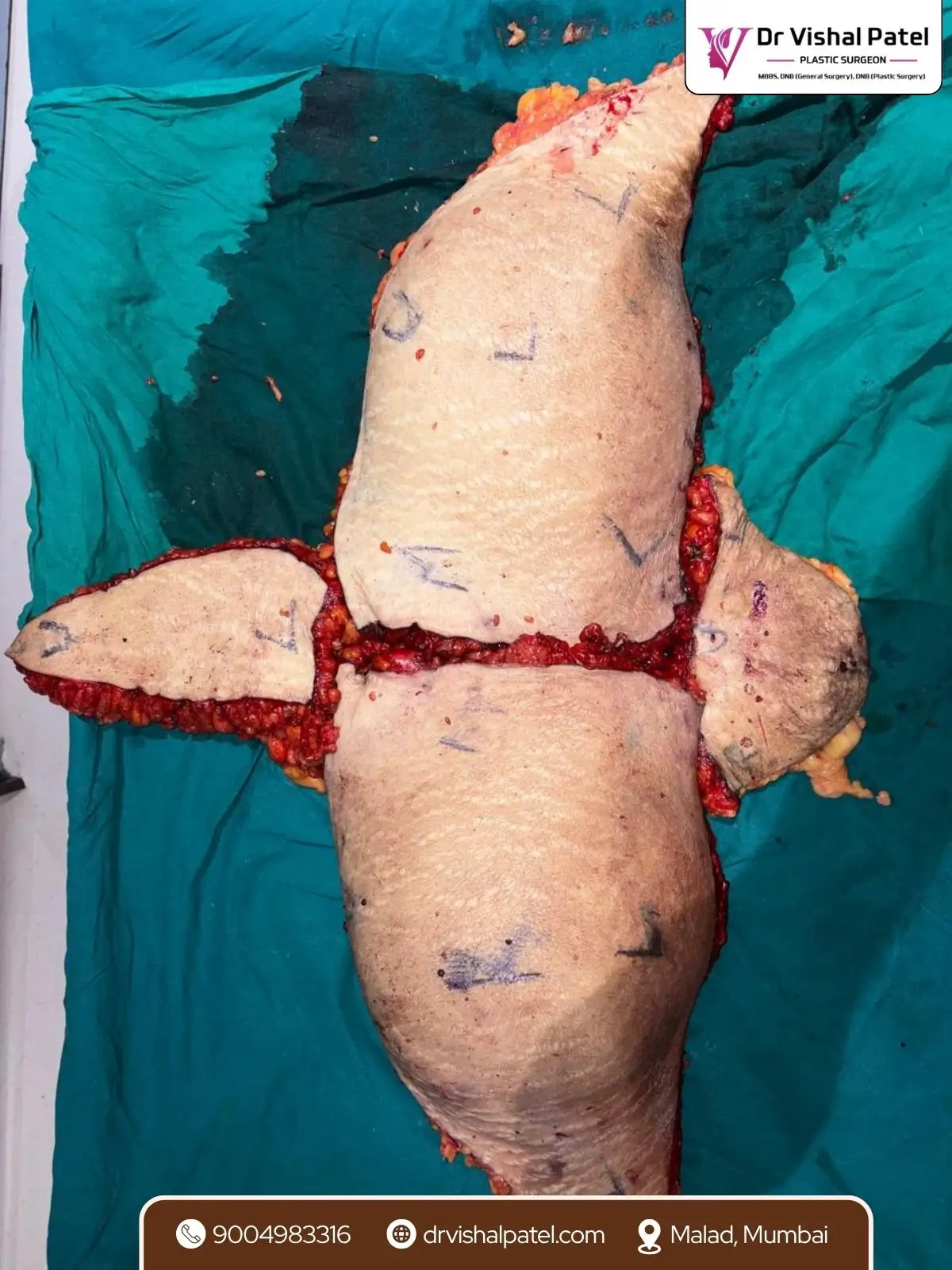 10Kg Excised Skin Flap from Tummy tuck surgery in Mumbai by Dr. Vishal Patel