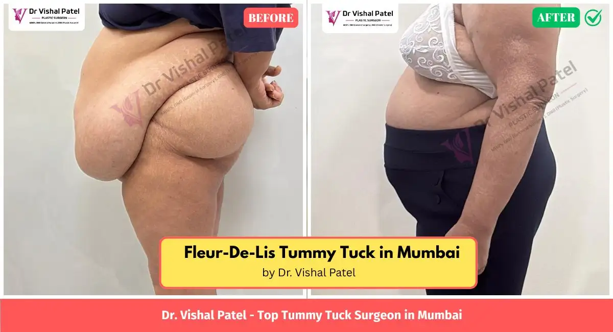 360 Liposuction before after photo in India - Left Side view - by Dr. Vishal Patel