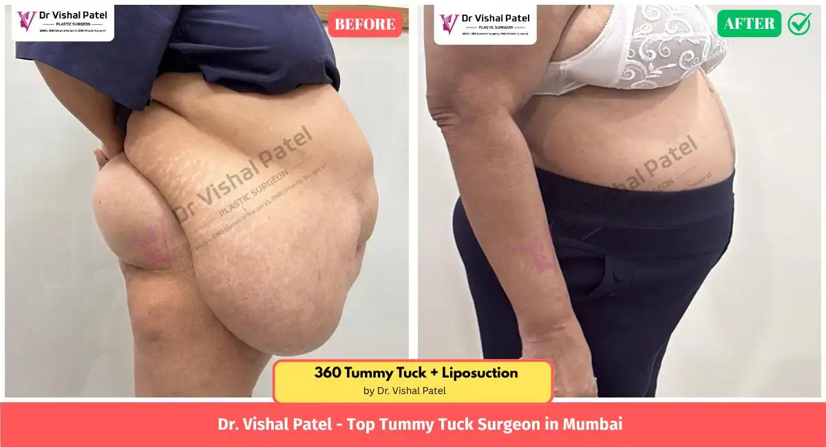 360 Tummy tuck picture - Right side view - Before After Photo in Mumbai by Dr. Vishal Patel