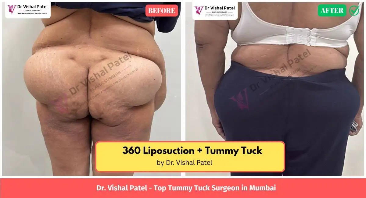 360 Tummy tuck picture backside - Before After Photo in Mumbai by Dr. Vishal Patel
