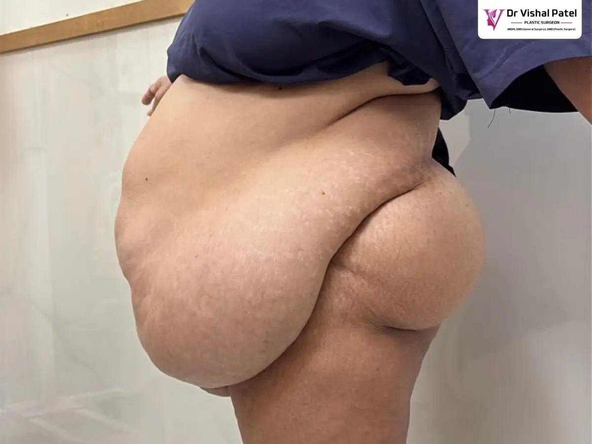 Canada Female before Fleur De Lis Abdominoplasty photo in Mumbai