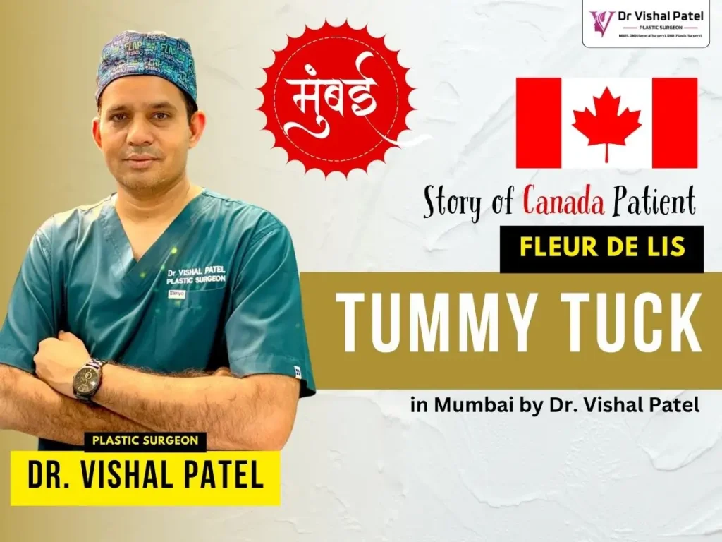 Case of Medical Tourism Fleur de lis Tummy Tuck in Mumbai by Dr. Vishal Patel