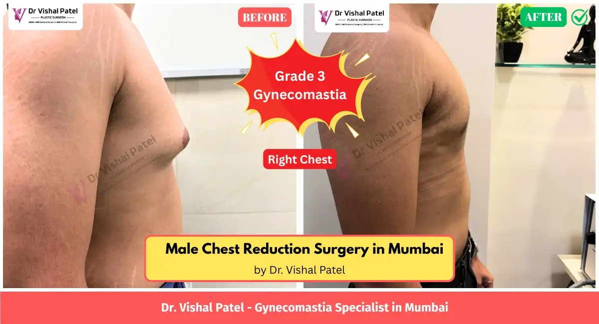 Right side view of Gynecomastia Surgery result in Mumbai.