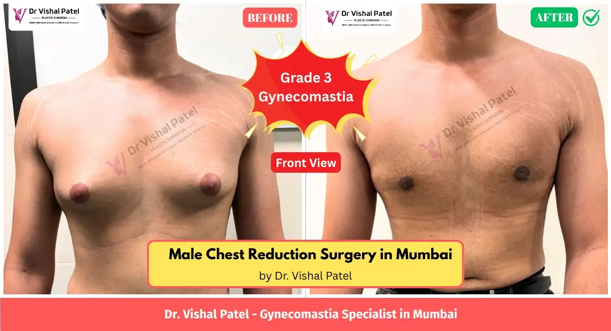 Front view of male chest reduction surgery in Mumbai.