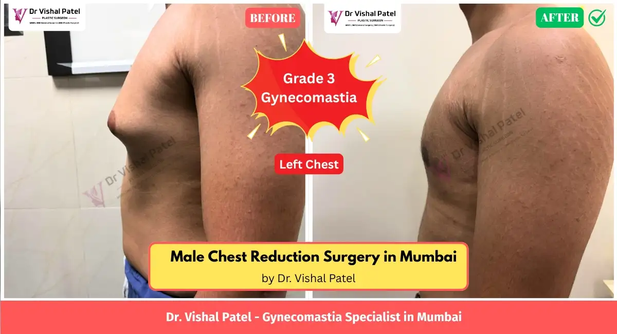 Left Side Chest View of Gynecomastia before after photos in Mumbai.