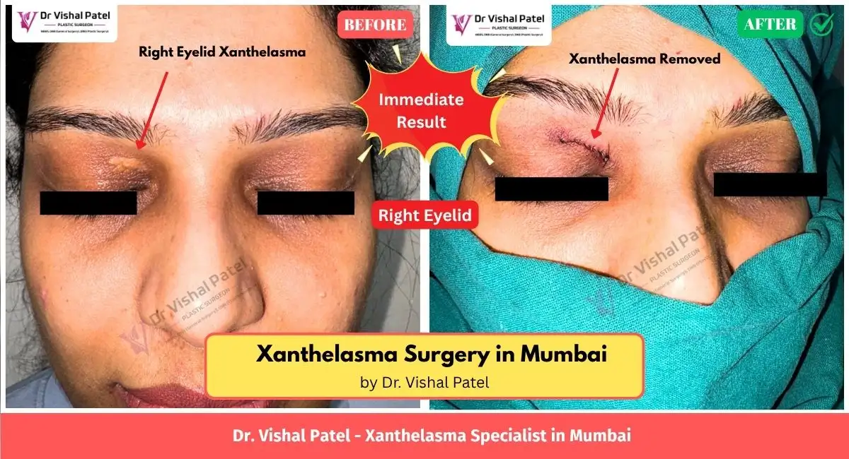 Right Eyelid Xanthelasma in Mumbai India - Before After Photo