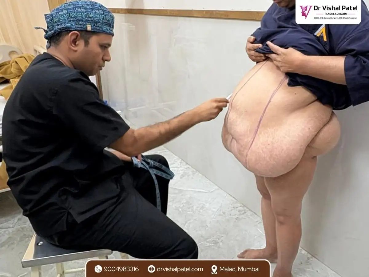 Dr. Vishal Patel doing front tummy tuck marking in Mumbai for female patient.