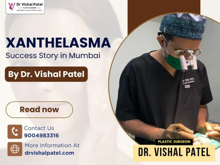 Xanthelasma Success Story in Mumbai by Dr. Vishal Patel