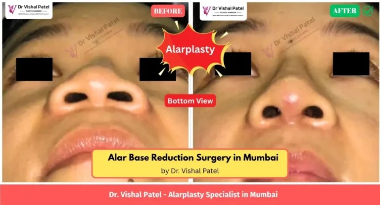 Alarplasty in Mumbai India - Before After Photos by Dr. Vishal Patel