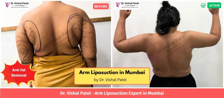 Arm Liposuction Before After Photo in India by Dr. Vishal Patel