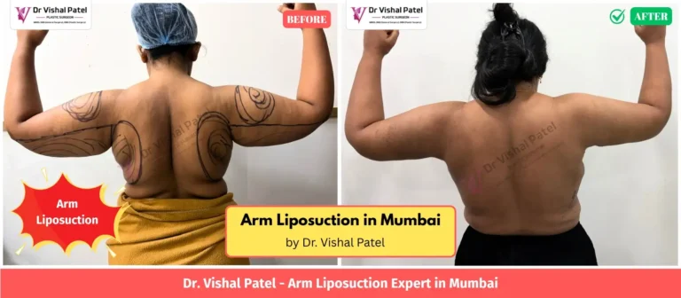 Arm Liposuction Before After Photo in Mumbai India by Dr. Vishal Patel