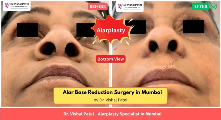 Alarplasty Before After Photo of Indian female in Mumbai. Bottom view.
