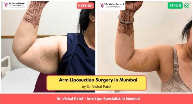 Arm Fat Removal surgery in Mumbai India by Dr. Vishal Patel - Before After Photo