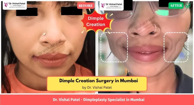 Dimple Creation Before After Photos in Mumbai by Dr. Vishal Patel