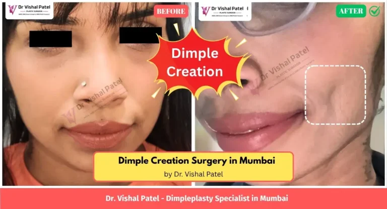 Dimple Creation Surgery in India - by Dr. Vishal Patel - Before After Photo