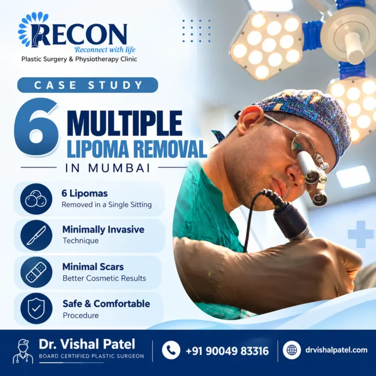 Multiple Lipoma Removal Case Study in Mumbai.
