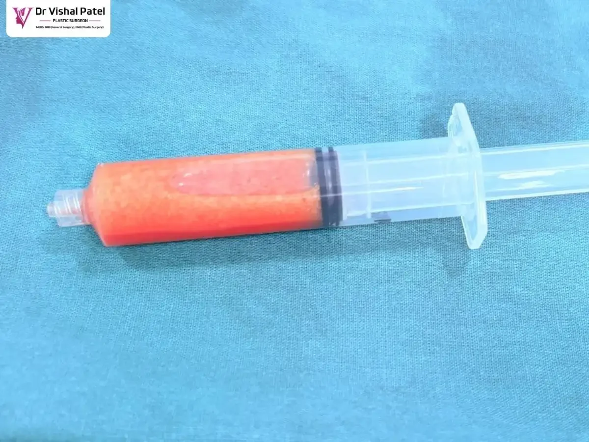 A Breast Enlargement Injection Full of Fat