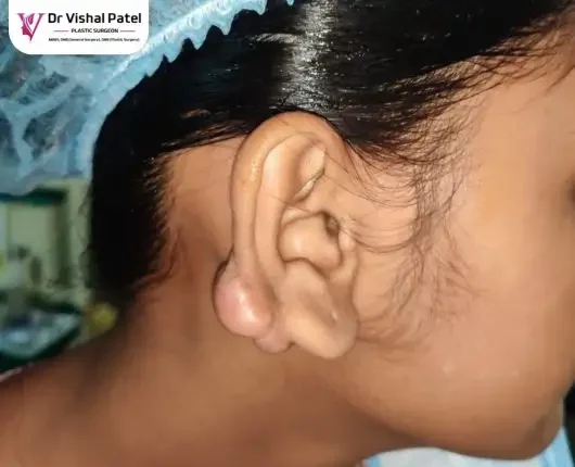 A keloid on the earlobe of young female in India