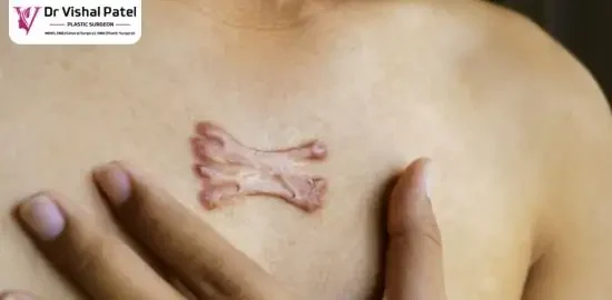 A large keloid on the chest