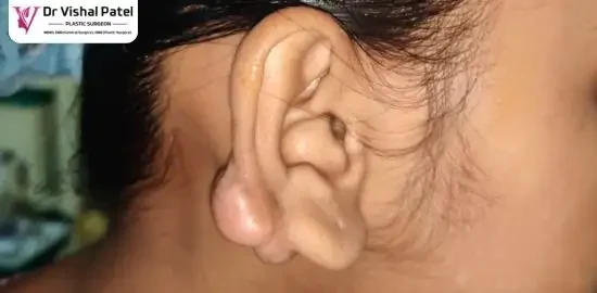 A large keloid on the ear